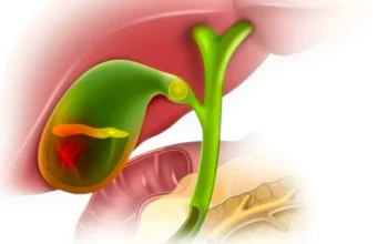 Холецістит – запалення жовчного міхура, що часто відбувається у людей старше 40 років. Симптоми, діагностика та способи лікування