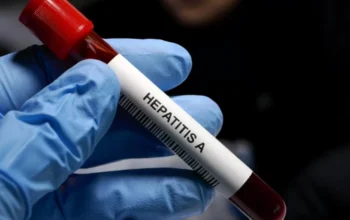 Вірусний гепатит А - гостре захворювання, що викликає серйозне ураження печінки. Ознайомтесь із симптомами, методами діагностики та лікування.